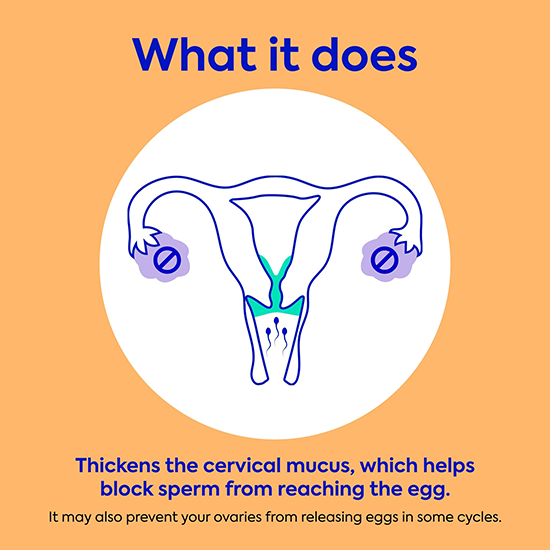 Diagram of how Opill works by thickening cervical mucus to help block sperm from reaching the egg